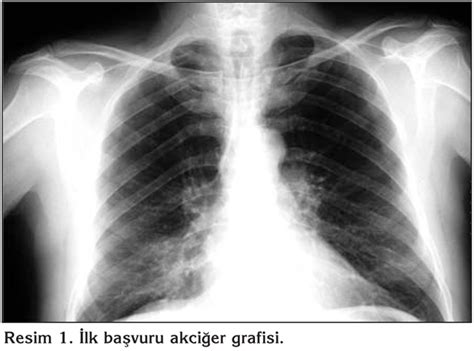 Bir hamartom, ürettikleri bölgede bulunan normal dokulardan oluşan iyi huylu (kanserli olmayan) bir tümördür. Girişimsel bronkoskopi ile tedavi edilen endobronşiyal ...