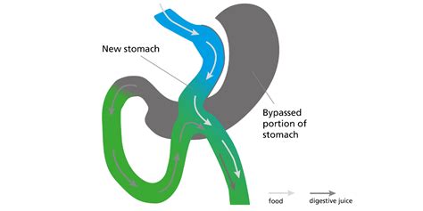 Laparoscopic Gastric Bypass And One Anastamosis Loop Gastric Bypass