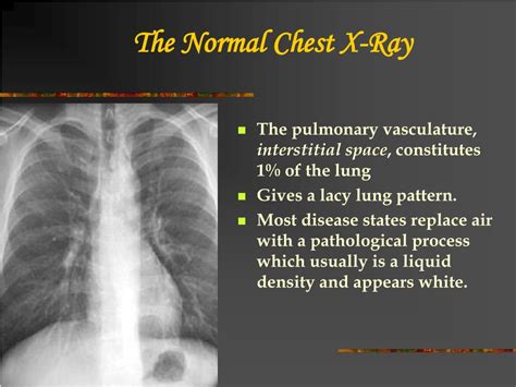 Ppt Chest X Ray Review Powerpoint Presentation Id172434