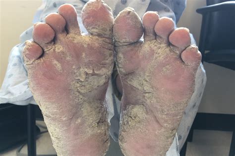 Thick, Yellow Skin on Soles of Feet - Clinical Advisor