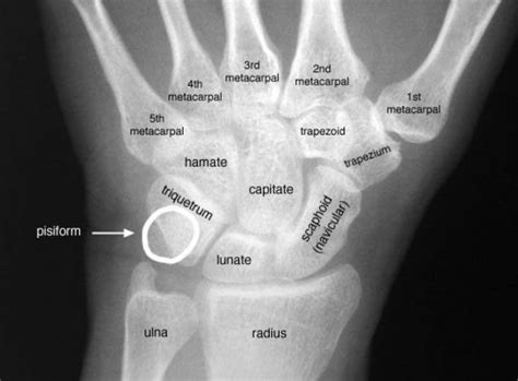 Radiographic Image Of Carpal Bones In The Hand Radiology Student