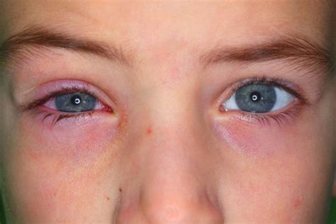 13 Symptoms Of Pink Eye Conjunctivitis In Kids And Treatment