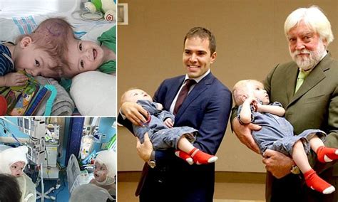 Once Conjoined Twins Seen For The First Time Without Their Bandages As