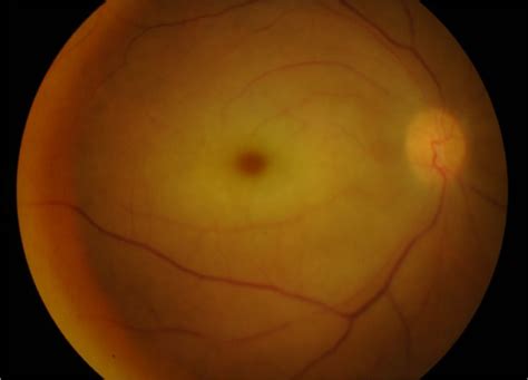 Cherry Red Spot Appearance Due To Central Retinal Artery Occlusion In