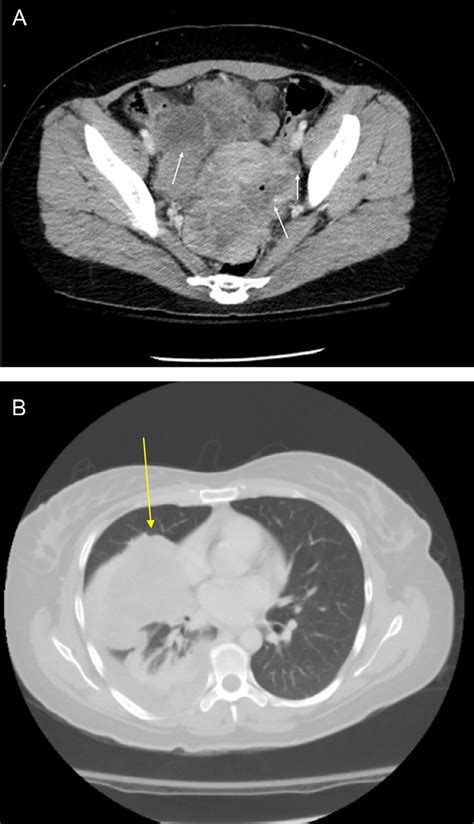 Ct Abdomen And Pelvis With Contrast Demonstrating Multiple
