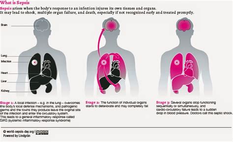Un simple movimiento puede cambiarlo todo. Comité de Infectología de CRS. : SEPSIS Y SHOCK SEPTICO