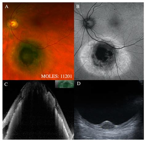 Choroidal Nevus With Lipofuscin