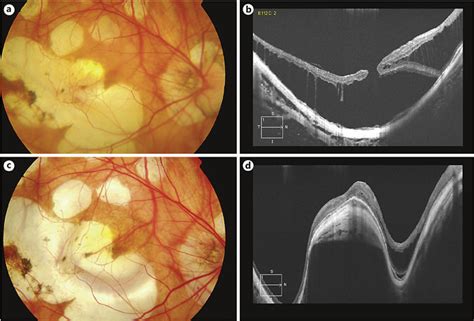 High Myopia With Posterior Staphyloma B Full Thickness Mh With