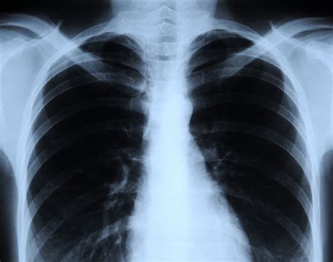 Lung Cancer Deaths Unchanged By Annual Chest X Rays Live Science