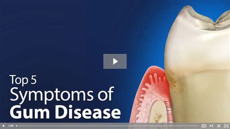 How To Know If You Have Gum Diseases Symptoms Causes Treatment