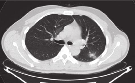 Ct Scan Of The Chest Demonstrates A Sub Pleural Nodule In The Left
