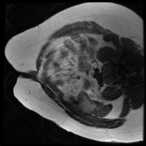 Umbilical Endometriosis Radiology Case