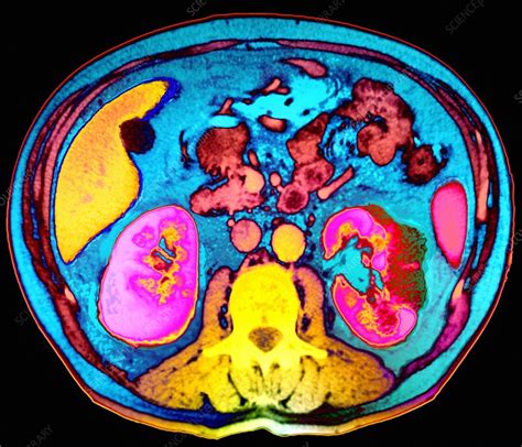Kidney Cancer Abdominal Ct Scan Stock Image M1340459 Science