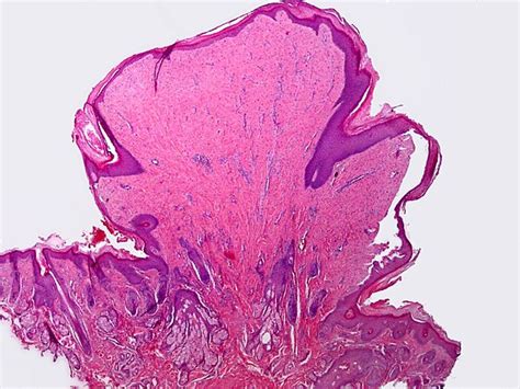 Fibroepithelial Polyp Libre Pathology