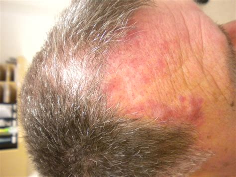 Lymphoma Skin Cancer Rash