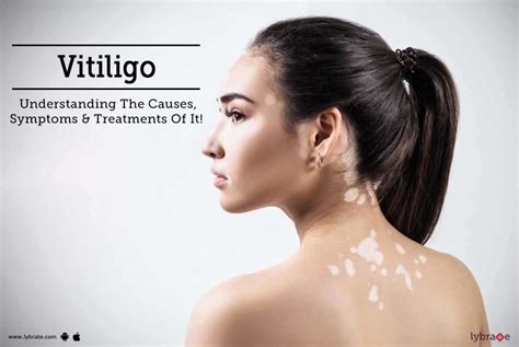 Vitiligo Understanding The Causes Symptoms And Treatments Of It By