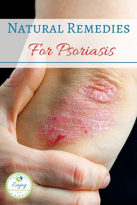 5 Natural Remedies For Psoriasis Psoriasis Remedies Psoriasis Diet