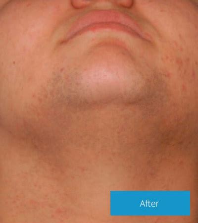 Signs of an infected ingrown hair include: Ingrown Hair - Serenity Aesthetics