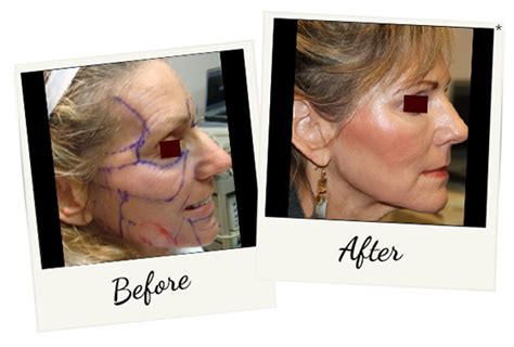 Stem Cell Facial Rejuvenation Riopelle Cosmetic In San Ramon