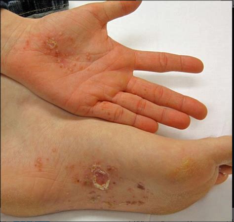 Dyshidrotic Eczema Dyshidrosis Symptoms Causes Treatment And