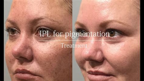 Ipl For Pigmentation Treatment Video Youtube