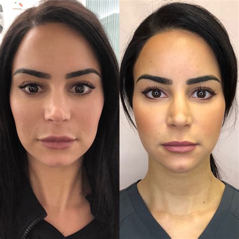 Kybella Before And After Images Medspa In Newport Beach Ca
