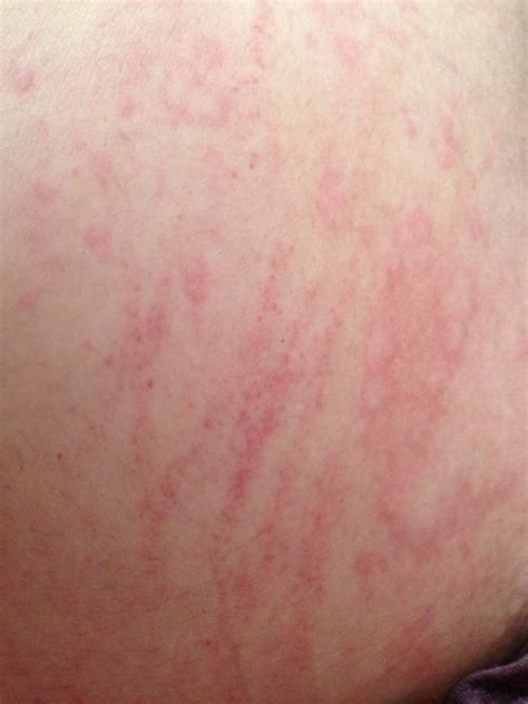 Hives Attack Febeth Diary Of A Domesticated Blogger