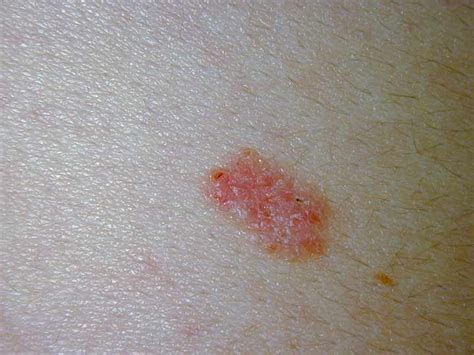 Skin Lesions That Are Not Cancer Cancerwalls