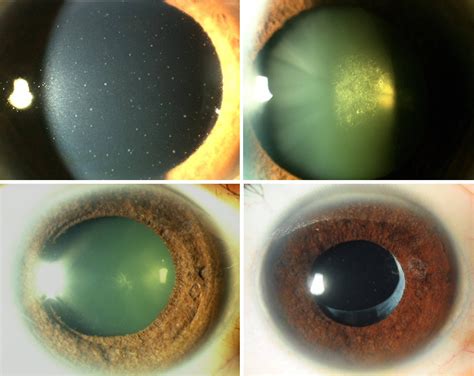 Demystifying Viral Anterior Uveitis A Review Chan 2019 Clinical