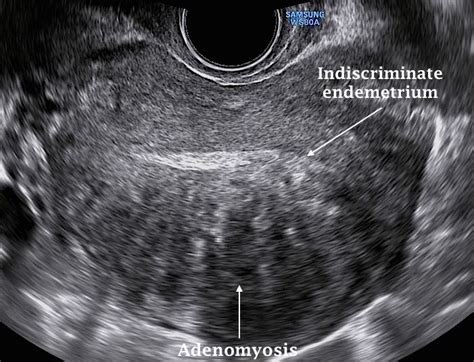 Adenomyosis vs endometriosis females are considered as the bearer of life and the hope of an entire species. Uterine Cause | Medical ultrasound, Ultrasound sonography ...