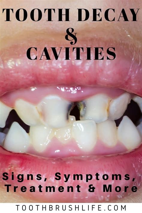Cavity Guide Tooth Decay Causes Symptoms Treatment Toothbrush