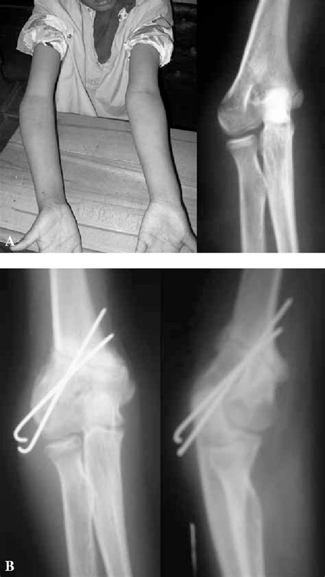 Figure 1 From The Equal Limbs Lateral Closing Wedge Osteotomy For