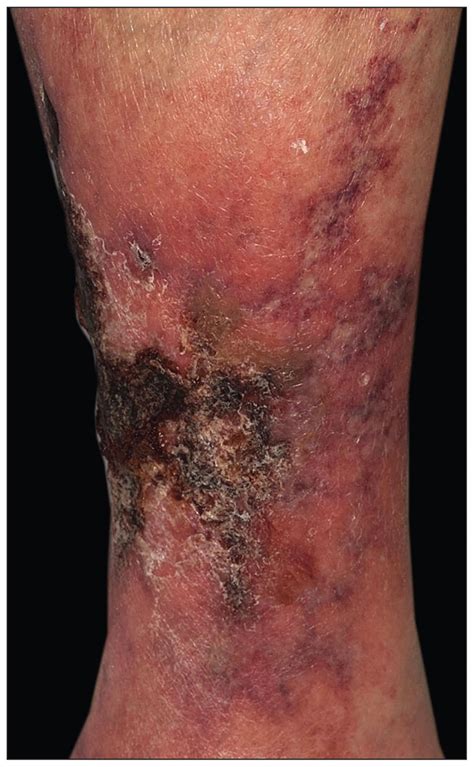 Acute renal failure occurs when renal function suddenly declines to very low levels, so that little or no urine is formed, and the substances, including even water, that the kidney normally eliminates are. Calciphylaxis: a severe complication of renal disease | CMAJ