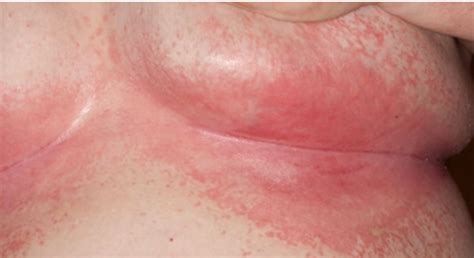 Skin Rashes Causes Symptoms And Treatment