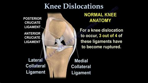 Knee Dislocations Everything You Need To Know Dr Nabil Ebraheim