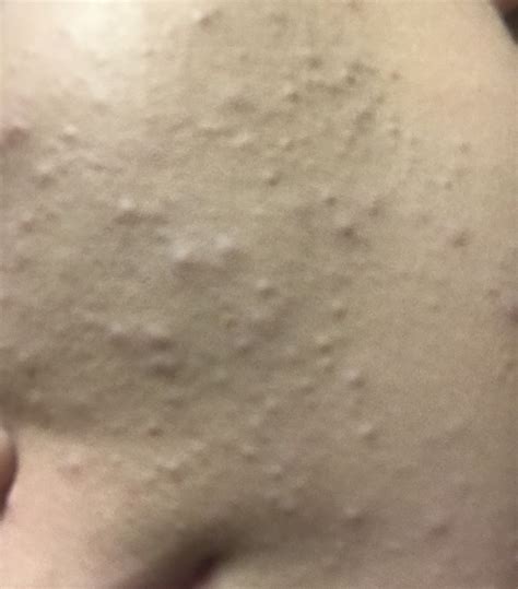 Small Bumps All Over My Face General Acne Discussion