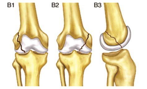 Distal Femur Ao Type 33 B Surgical Options Results And Complications