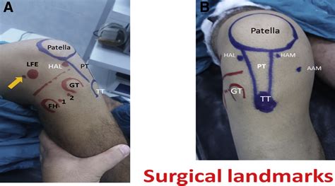 Combined Anatomic Anterior Cruciate Ligament And Double Bundle