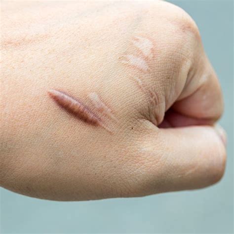 How To Get Rid Of Scars Dermatologist Tips On How To Remove Old Scars