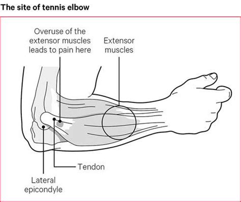 How To Cure Elbow Pain Shopfear0