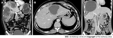 Amebic Liver Abscess Clinico Radiological Findings And Interventional