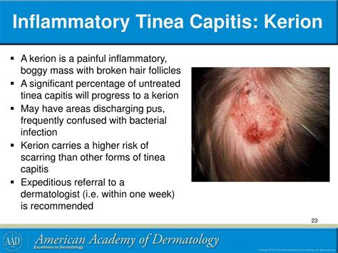 Ppt Pediatric Cutaneous Fungal Infections Powerpoint Presentation