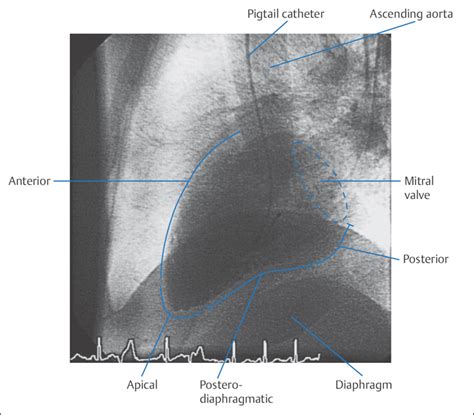 Catheterization Of The Cardiac Chambers Thoracic Key