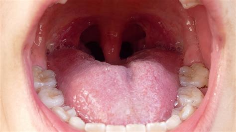 What Are Tonsil Stones — And How Do You Know If You Have Them Fox News