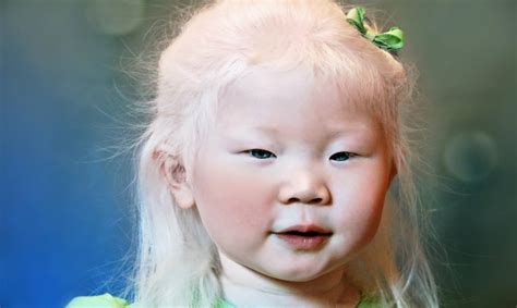 Curiosidades Sobre El Albinismo