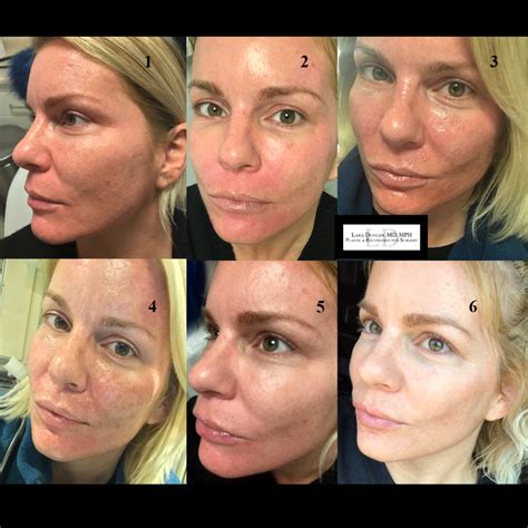 Phenol Chemical Peel Before And After