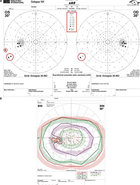 Case 1 A 30 ° Threshold Related Slightly Supraliminal Automated