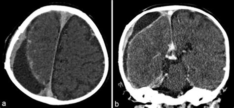 Pediatric Middle Meningeal Artery Embolization For Chronic Subdural