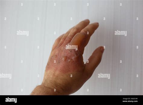 Burn Blister Arm Hi Res Stock Photography And Images Alamy