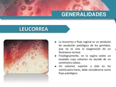 Leucorrea